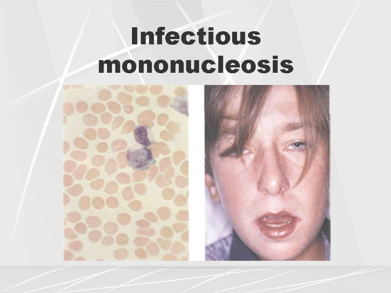 Infectious mononucleosis